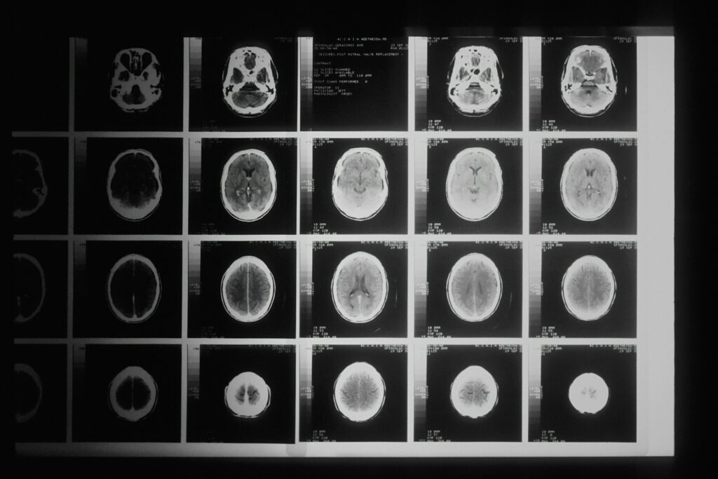 Do You Need a Brain Injury Lawyer in Phoenix? Here’s What to Consider